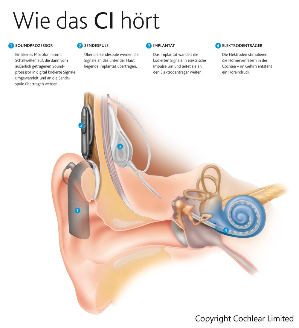 Aufbau und Funktionsweise eines Cochlea-Implantats
