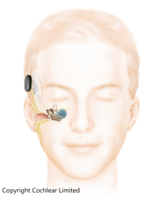 Cochlear-Implantant Overview